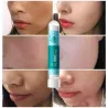Acne treatment - blackhead remover - brightening mask with hyaluronic acid snail essence 10 pieces